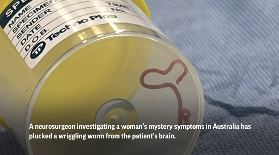 Worm pulled from woman's brain